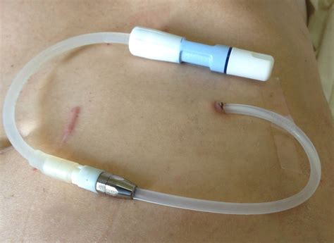 Tenckhoff Peritoneal Dialysis Catheter