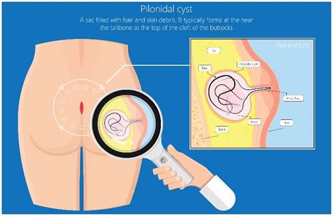 Pilonidal Cyst Home Treatment Causes Symptoms Prevention