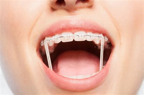 Rubber Bands On Braces Purpose Wigal Orthodontics