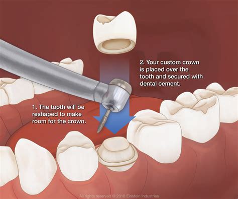 How much of a tooth is needed for a crown? Dental Crowns by Dr. Bruce Wilderman in Philadelphia