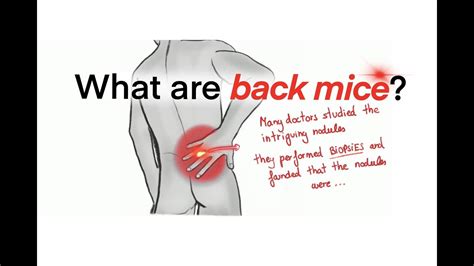 What Are Back Mice Lumbar Nodules An Overlooked Cause Of Low Back