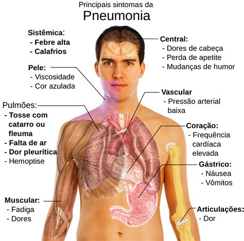 Pneumonia Aguda Pneumonia Causas Sintomas Tipos Tratamento My Xxx Hot The Best Porn Website