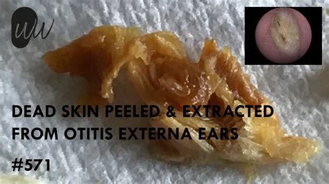571 Dead Skin Peeled And Extracted From Infected Otitis Externa Ears