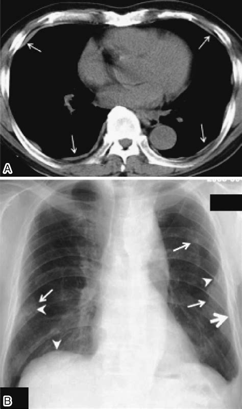 Examples Of Pleural Plaques On A A Chest Ct Arrows Indicate Pleural