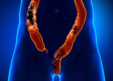 Cancer colorectal : facteurs de risque, symptômes ...