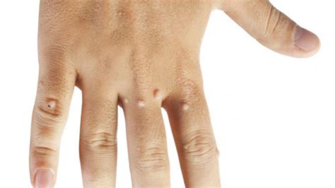How To Get Rid Of Warts On Hands What Causes Of Hand Warts