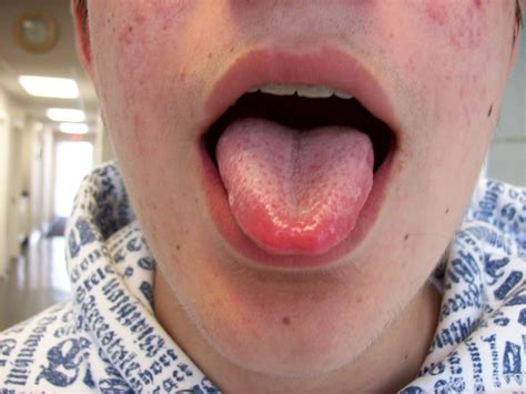 Red Patches On Tongue