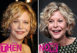 Women Meg Ryan Plastic Surgery Before And After