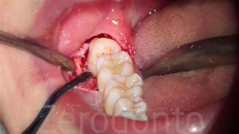Complex Removal Of A Wisdom Tooth In The Lower Jaw Youtube