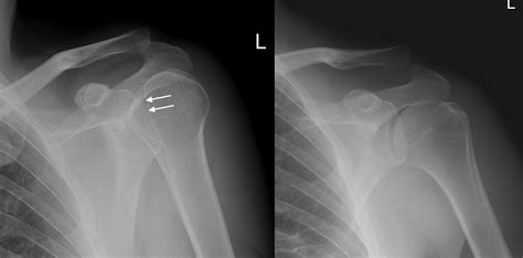 Posterior Shoulder Dislocation Radiology At St Vincents University