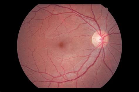 Diagnose My Retinal Photograph Myelinated Nerve Fiber Layer Eyedolatry