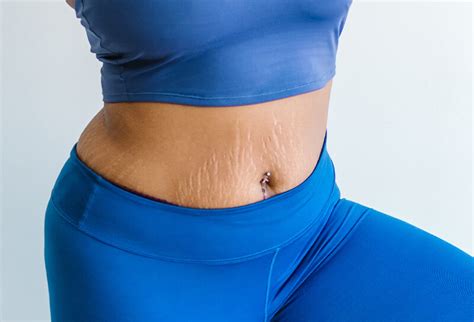 Fast Effective Ways To Hide Stretch Marks On Your Stomach