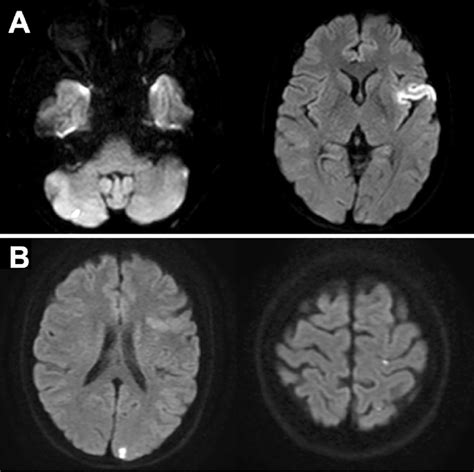 Figure1a Diffusion Weighted Magnetic Resonance Imaging Dwi Revealed