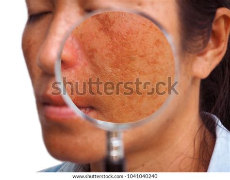 Close Melasma On Woman Face Skin Stock Photo Edit Now 1041040240