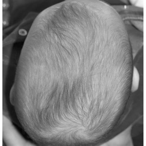 Pdf Torticollis And Plagiocephaly In Infancy Therapeutic Strategies