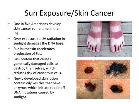 Ppt Sun Exposureskin Cancer Powerpoint Presentation Free Download