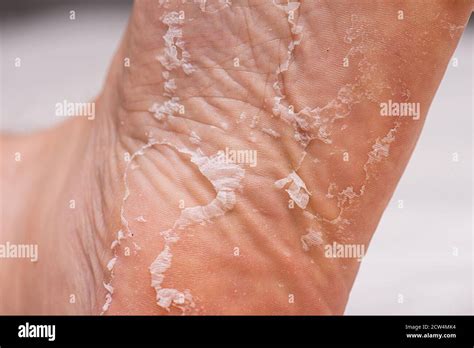Skin Peeling On The Sole Of A Foot Stock Photo Alamy