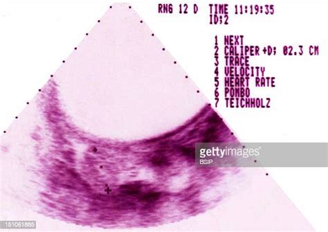 Uterine Rupture Fotografías E Imágenes De Stock Getty Images