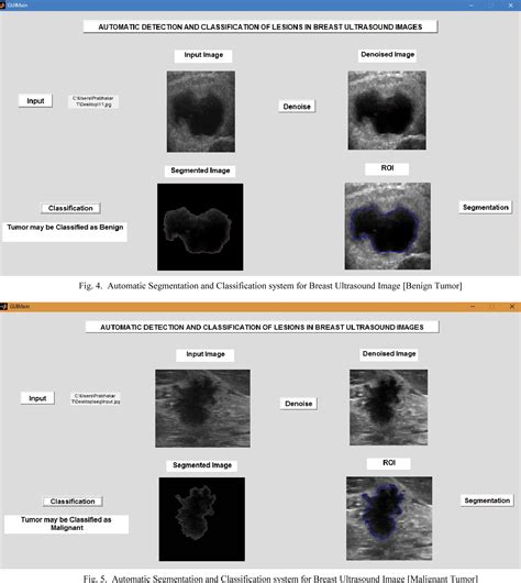 Automatic Detection And Classification Of Benign And Malignant Lesions