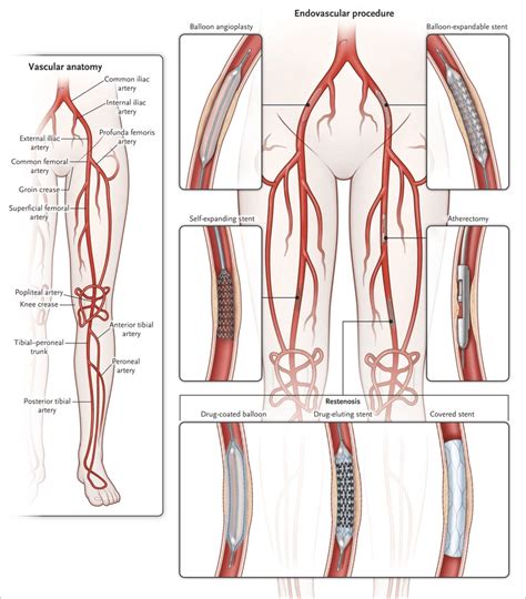 Peripheral Artery Disease Pad Center For Advanced Cardiac And