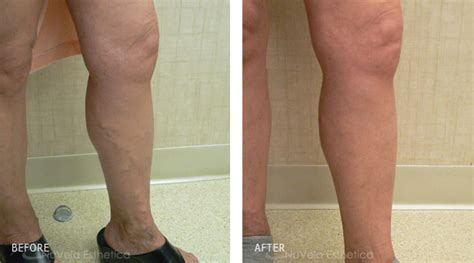 Superficial Bulging Vein Treatment With Foam Sclerotherapy