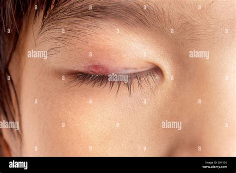 Stye Infection Hi Res Stock Photography And Images Alamy