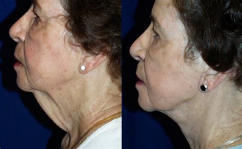 Before And After Neck Lift To Tighten Neck Muscle Dr Rodriguez