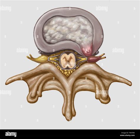 Illustration Herniated Spinal Disk Hi Res Stock Photography And Images