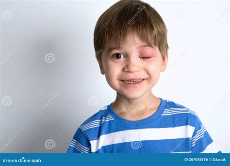 A Boy With Swollen Eye From Insect Bite Quincke Edema Portrait Of