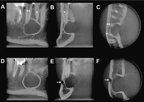 Figure 1 From Anterior Stafnes Bone Cavity Mimicking A Periapical
