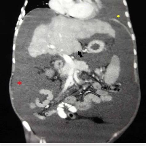 Axial Contrast Computed Tomography Ct Obtained During Venous Portal