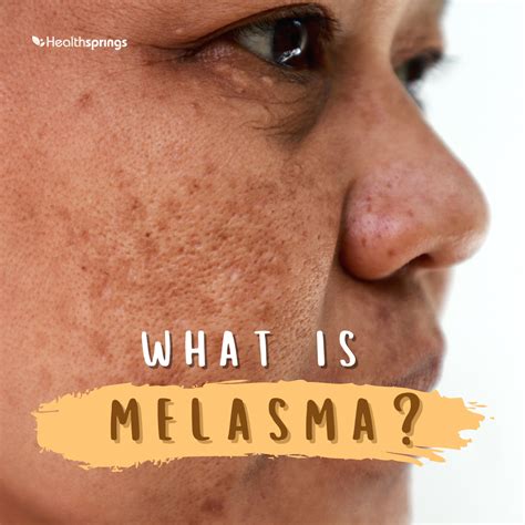 Melasma Treatment Singapore How To Treat Melasma