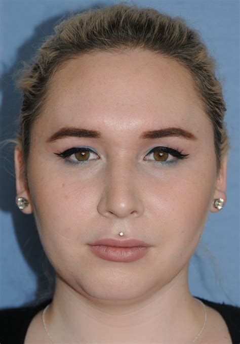 Rhinoplasty Before And After Photos Seattle Bellevue