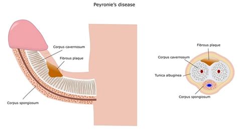 What Is Peyronies Disease