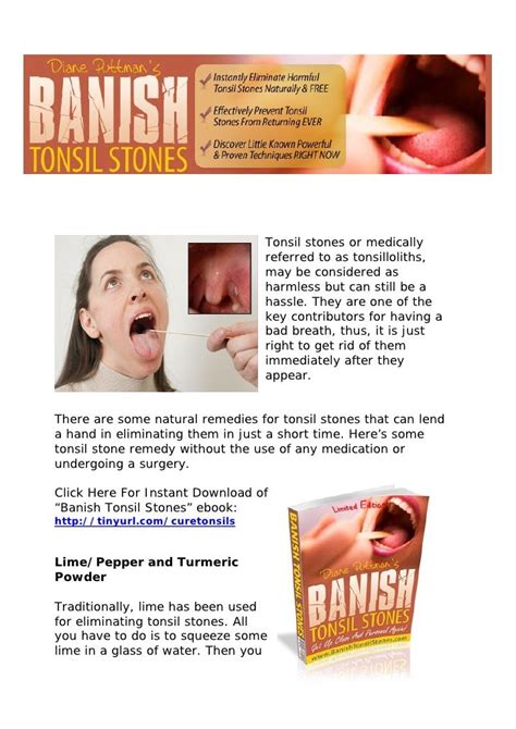 A Simple Guide To Cure Tonsil Stones