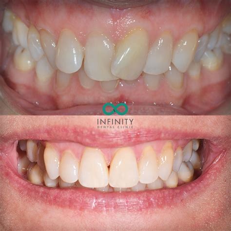 Straighter Teeth With Invisalign At Infinity Dental Clinic Leeds