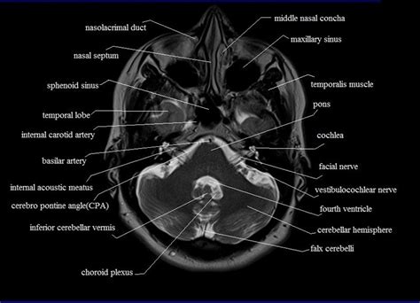 Mandibular nerve accessory meningeal artery lesser petrosal nerve. MRI anatomy brain axial image 6