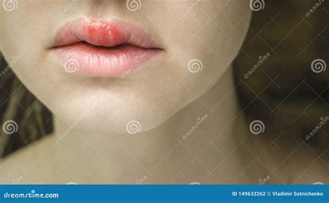 Symptom Of Herpes Zoster Shingles Royalty Free Stock Photography