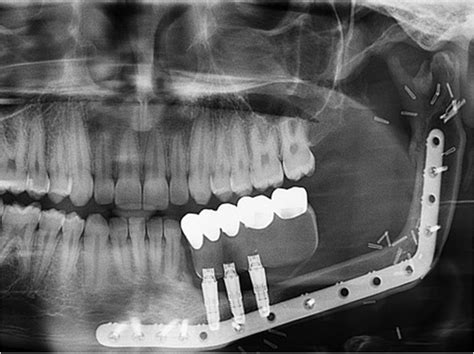Bone Replacement Procedure Successfully Treats Children With Jaw Tumors