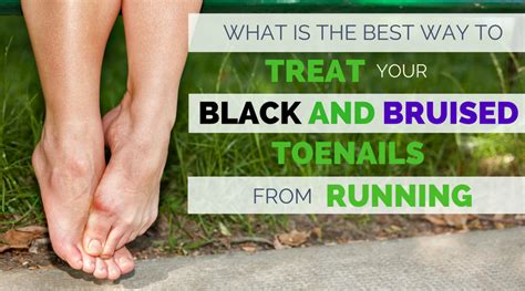 What Is The Best Way To Treat Black And Bruised Toenail From Running