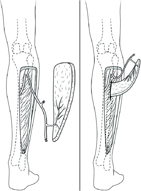 Left A Peroneal Flap Based On The Distal Perforator Is Raised To The