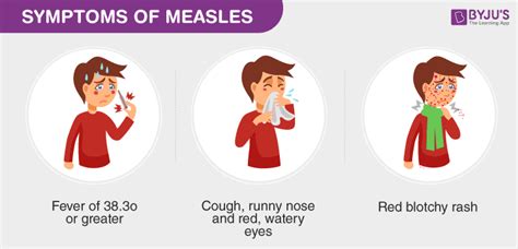 Measles Causes Symptoms Treatment Prevention