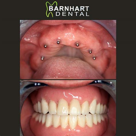 Gallery Mini Implant Supported Dentures Barnhart Dental