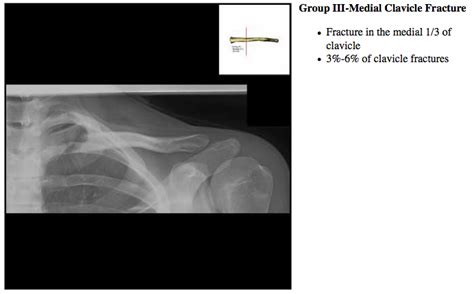Clavicle Fracture Medial S42023a 81002 Eorif