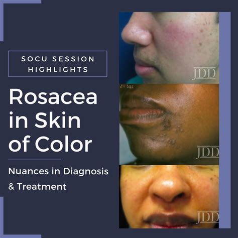 Rosacea In Skin Of Color Patients Nuances In Diagnosis And Treatment