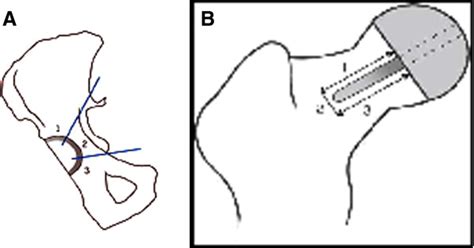 A Acetabular Radiolucency Zones According To Delee And Charnley