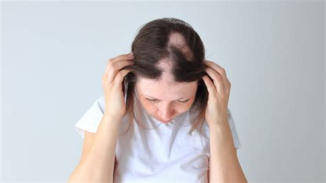Can You Grow Your Hair Back After You Have Alopecia