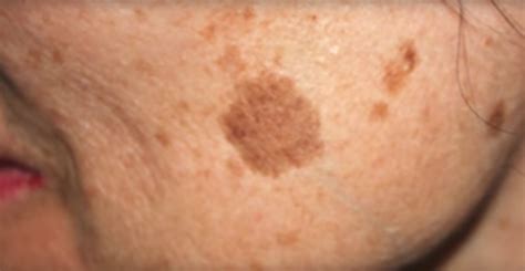 Age Spots Also Known As Liver Spots Are Brown Markings That Appear On