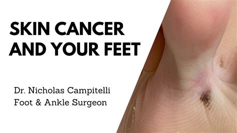 Skin Cancer And Your Feet Dr Nicholas Campitelli Youtube