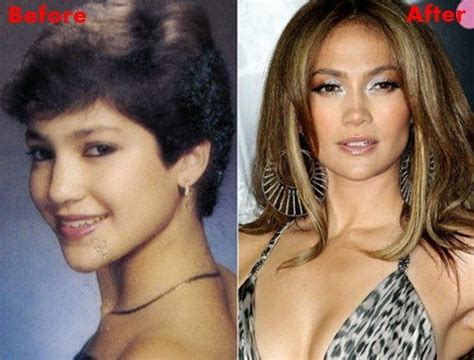 Jennifer Lopez Plastic Surgery Before And After Plastic Surgery News